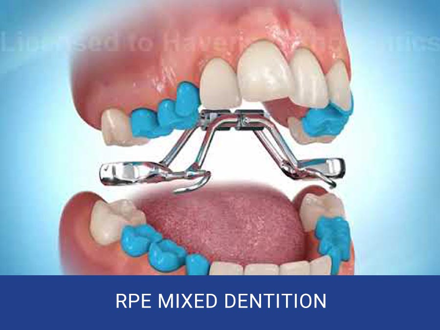 RPE Mixed Dentition